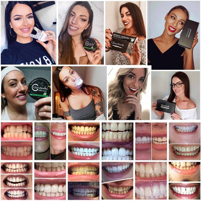 Read more about the article Why People Prefer GlorySmile Teeth Whitening Products?