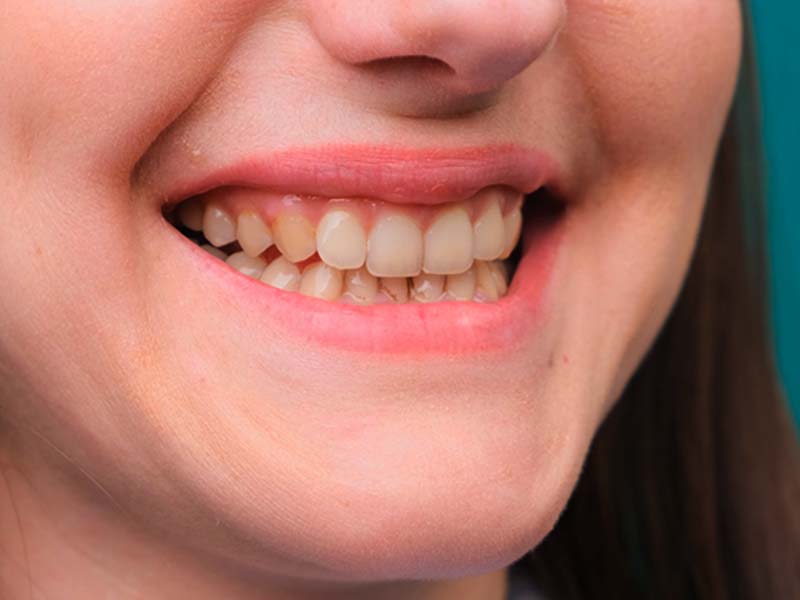 V34 Teeth Colour Corrector Serum - GlorySmile